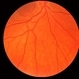 Hollenhorst Plaque in Eye with BRAO Hollenhorst Plaque in Eye with BRAO
